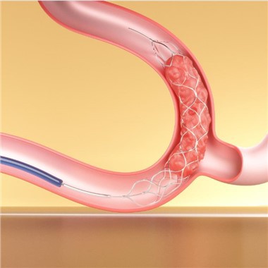 Stent Retriever Thrombectomia eszközök